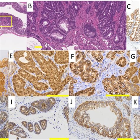 Histopathology Results Of Hande Staining And β Catenin Immunostaining Of