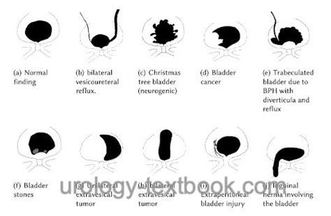 Voiding Cystourethrography Vcug Examination Technique And Normal