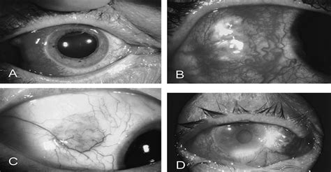 The Diagnosis And Management Of Anterior Scleritis International