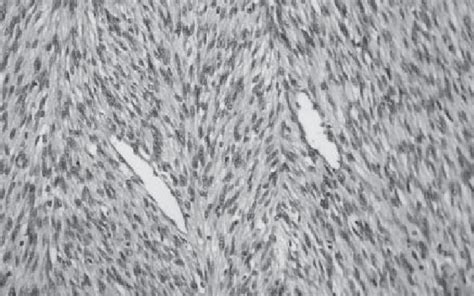 Intersecting Fascicles Of Spindle Shaped Tumor Cells Hematoxylin