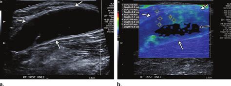 Large Popliteal Baker Cyst In A Year Old Woman A Long Axis