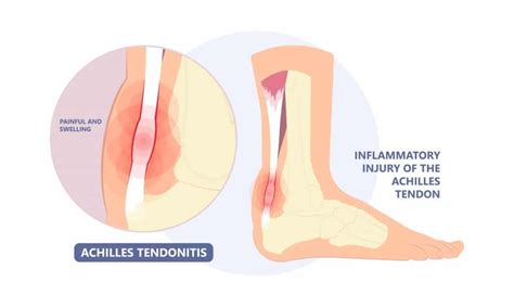 Achilles Tendonitis Understanding Achilles Tendinitis Pain