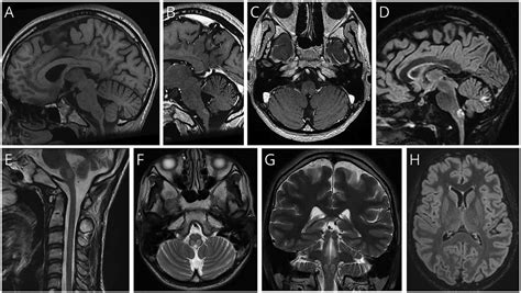 Area Postrema Syndrome As The Initial Presentation Of Alexander Disease