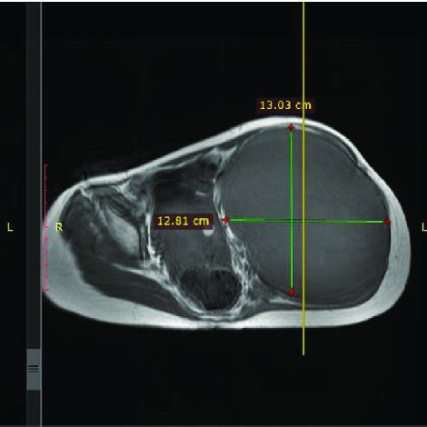 MRI showing a large heterogeneously enhancing and erosive mass lesion ...