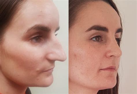 Before And After Rhinoplasty 85 Cosmeditour