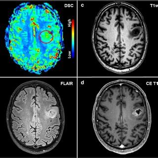 Perfusion Mri And Vessel Architectural Imaging Vai Merging Two