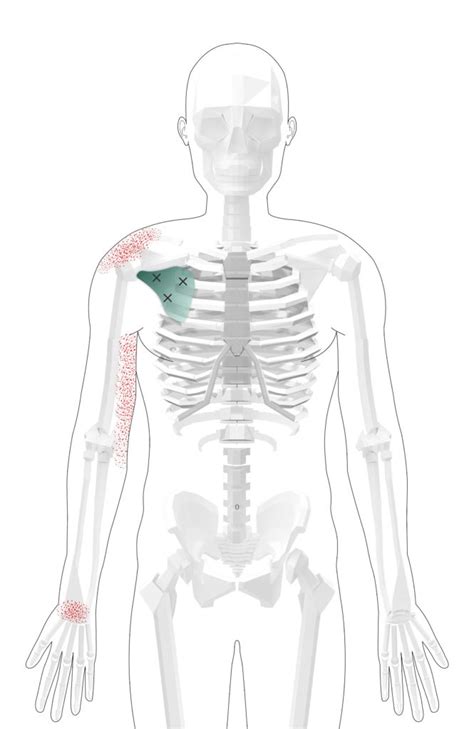 Subscapularis Trigger Points Overview Self Treatment Tips