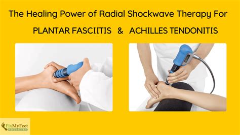 The Healing Power Of Shockwave Therapy For Plantar Fasciitis And Achilles Tendonitis Greg