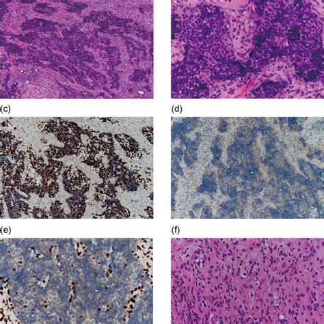 A E The Histology Of The Biopsy From The Cervical Lymph Node A Download Scientific Diagram