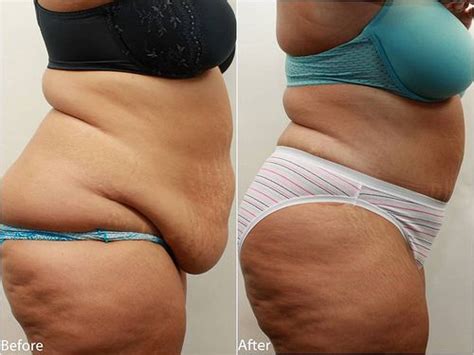 Dr Darm Tummy Tuck Before And After Tv Slide2 Flats The Plastics