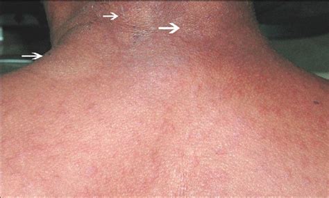 Sparing Phenomena In Dermatology Indian Journal Of Dermatology