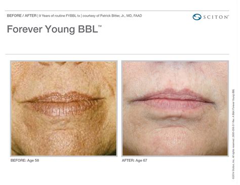 FOREVER YOUNG BBL™ - Sciton Australia & New Zealand