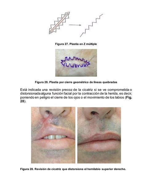 INCISIONES QUIRURGICAS EN CARA Y CUELLO PDF