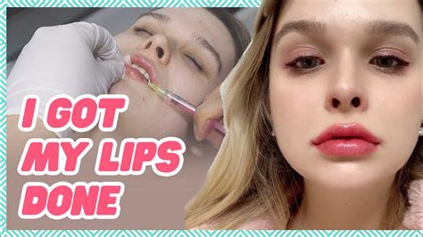 Natural Looking And Fuller Lips With Korean Lip Fillers Step By Step Before And After Youtube