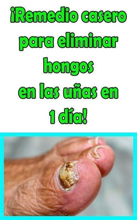HONGOS EN LAS UÑAS: CINCO REMEDIOS CASEROS PARA ELIMINARLOS - Doctor ...