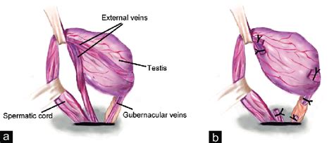 Gubernacular And External Spermatic Veins Are Stripped A The Testis