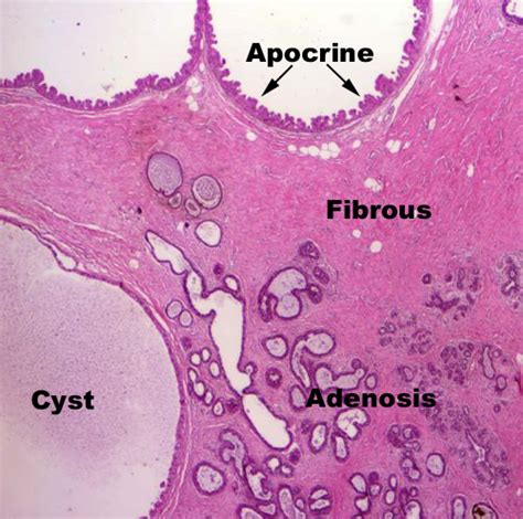 Fibrocystic Changes