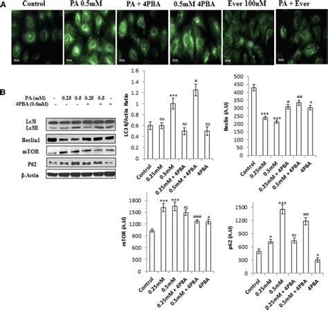 Palmitate Impaired Autophagic Process In Human Hepatocellular Carcinoma