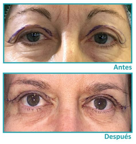 Blefaroplastia párpados abiertos y ojos bonitos