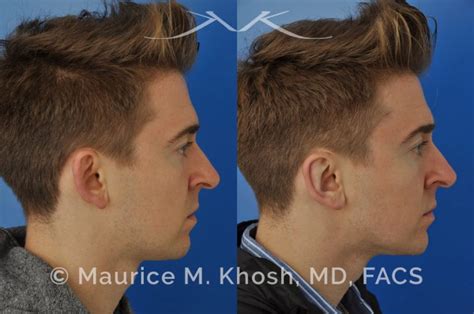 New York Ear Pinning Otoplasty Maurice M Khosh Md Facs