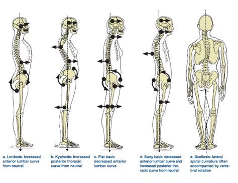 Swayback Secrets How To Fix Sway Back Posture Fm Physio