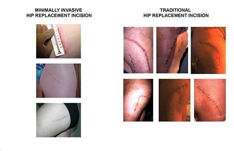 General Information For Patients Mini Total Hip