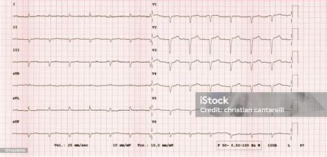 Ecg 12lead Rhythm Rare Pathology Amyloidosis Stock Illustration