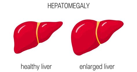 10 Things To Know About Hepatomegaly Facty Health