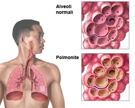 Polmonite Sintomi Cura Cause E Diagnosi MeteoWeb