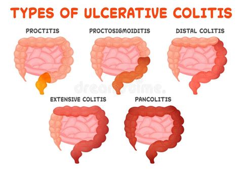 Ulcerative Colitis Types Gut Disease Intestine Inflammation From