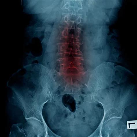 Herniated Disc Symptoms Causes Diagnosis And Treatments Cmw