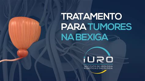 Tratamento para TUMOR DA BEXIGA Câncer de bexiga YouTube