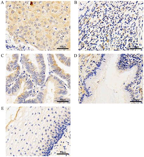 Expression Of BMP7 In Cervical Cancer And Inhibition Of Epithelial