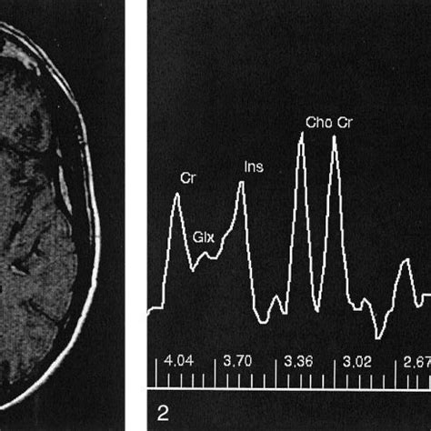 Typical Single Voxel Stimulated Echo Acquisition Mode Spectrum From A