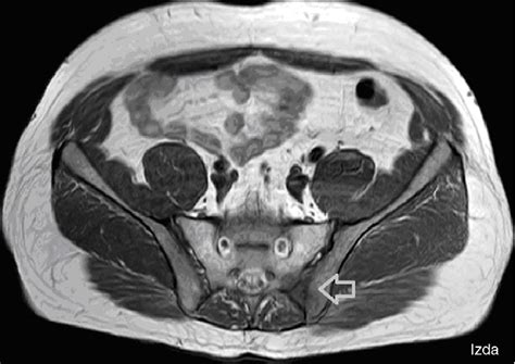 Figure 1 From Sacroiliitis And Gluteal Abscess Secondary To