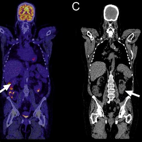 A 59 Year Old Woman With Fever Of Unknown Origin Low Dose FDG PET CT