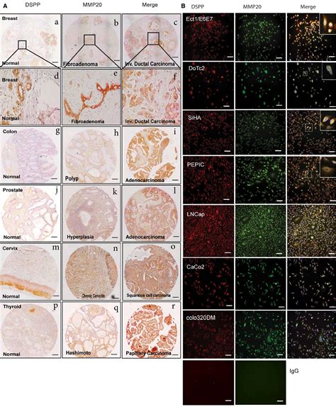 Survey Of Dentin Sialophosphoprotein And Its Cognate Matrix Metalloproteinase‐20 In Human