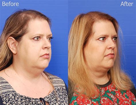 Kybella In San Diego Non Surgical Double Chin Reduction — Sky Facial