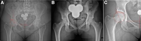 Three Dimensional Computed Tomography Reconstructions May Detect Pincer