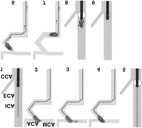 Photographs Illustrating The Merci Extraction Procedure 1 The Guide