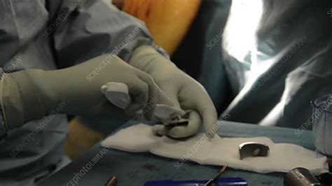 Partial Knee Replacement Surgery Stock Video Clip K003 0084