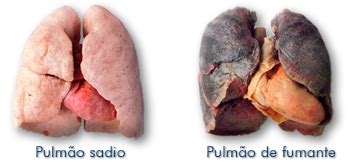 O Que Acontece Os Pulm Es Quando Se Para De Fumar Lully Fm