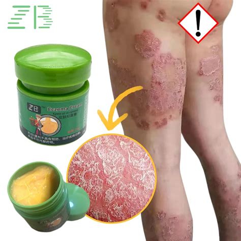 Crema De Tratamiento De Psoriasis A Base De Hierbas Antibacteriana