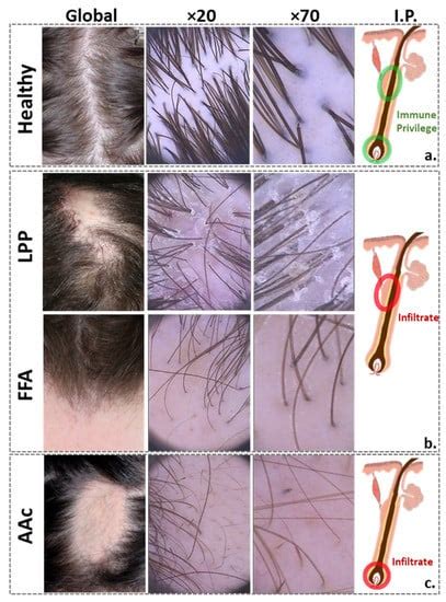 Biomedicines Special Issue Hair Pathology