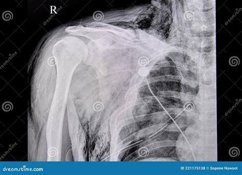 Chest Xray Film Of A Patient With Fracture Of Left Clavicle Ribs 2rd