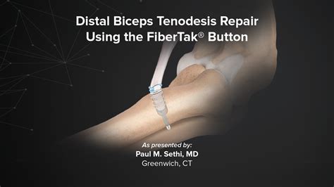 Arthrex Distal Biceps Tenodesis Repair Using The Fibertak Button