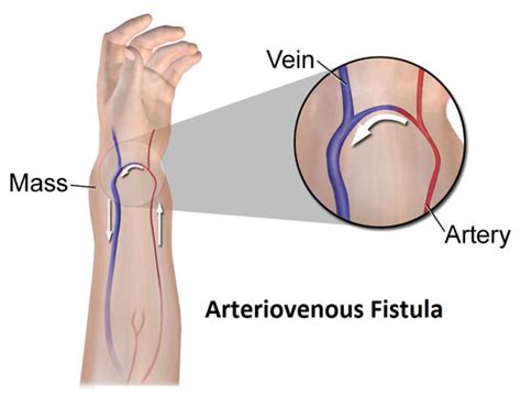 Dialysis Fistula Diagram