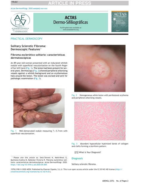 Pdf Solitary Sclerotic Fibroma Dermoscopic Features