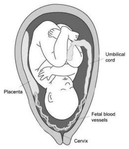 Pregnancy Complications - Vasa Praevia | Obstetric Excellence