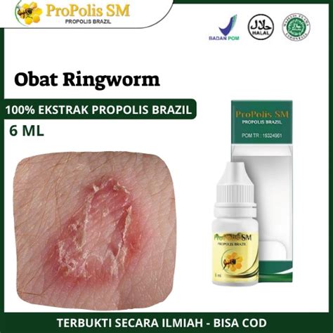 Jual Propolis Sm Obat Ringworm Manusia Infeksi Kulit Jamur Ruam